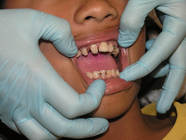 parodontoza