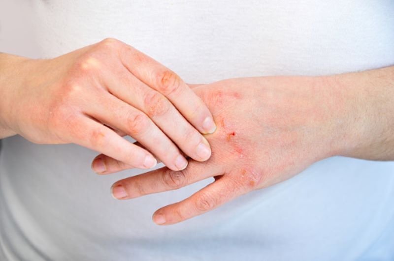 atopijski dermatitis prehrana