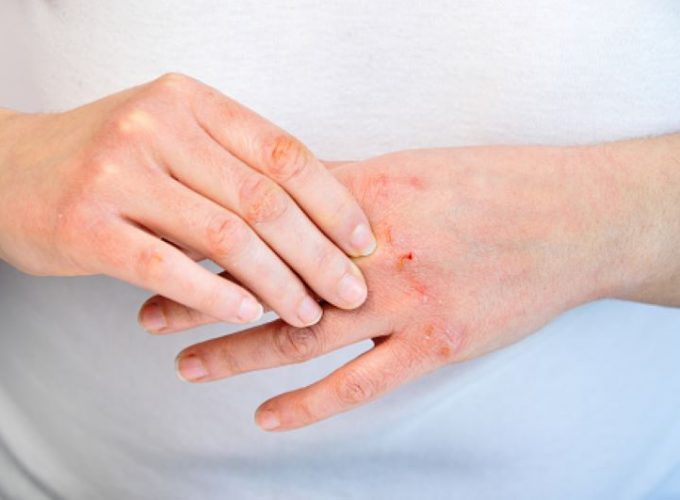 atopijski dermatitis prehrana